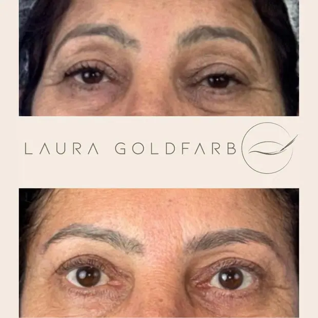 Caso real de blefaroplastia. Correção de ptose palpebral e blefaroplastia superior estruturada.