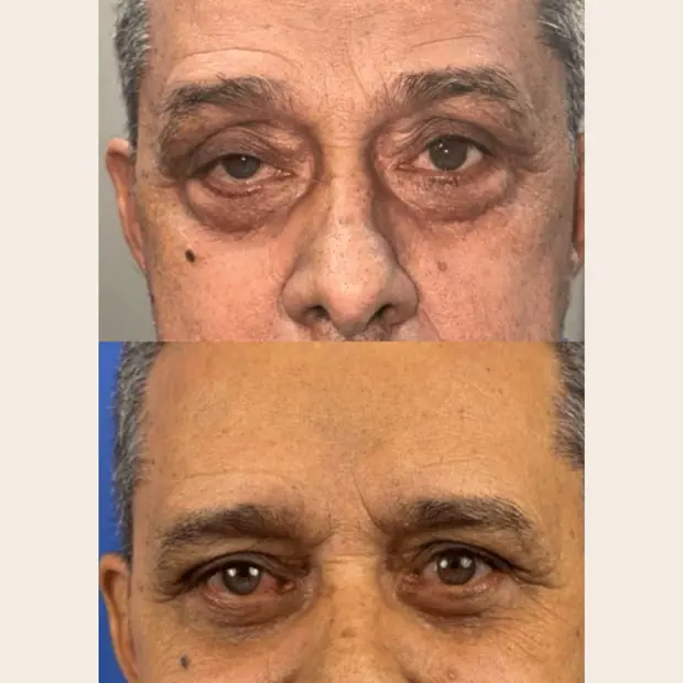 Caso real de blefaroplastia. Blefaroplastia superior e inferior e cantopexia. 30 dias de pós-operatório.