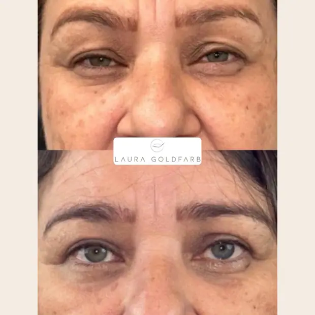 Caso real de blefaroplastia. Ptose, blefaroplastia superior e cantopexia. 30 dias de pós-operatório.