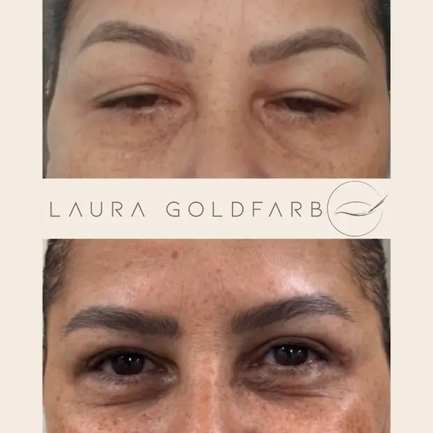 Blefaroplastia, antes e depois. Ptose de supercilios, blefaroplastia superior e cantopexia.