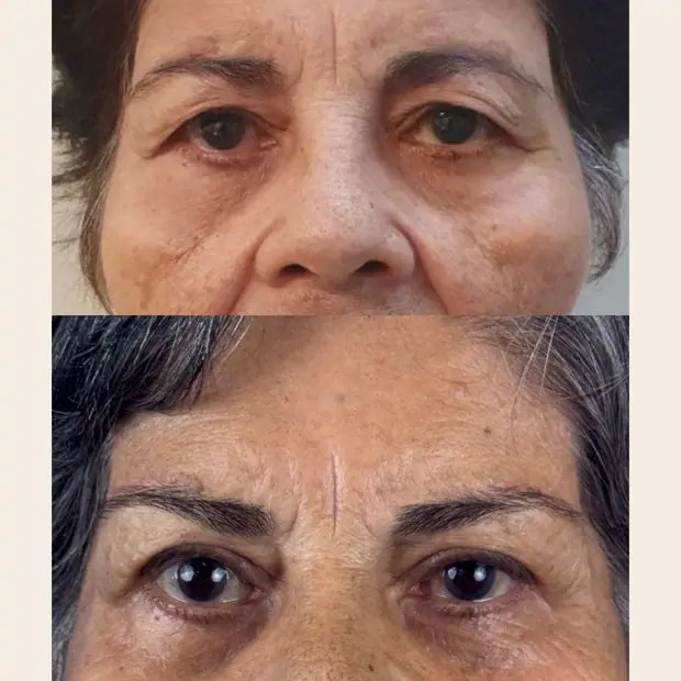 Blefaroplastia, antes e depois. Ptose palpebral, blefaroplastia superior e cantopexia com lift.