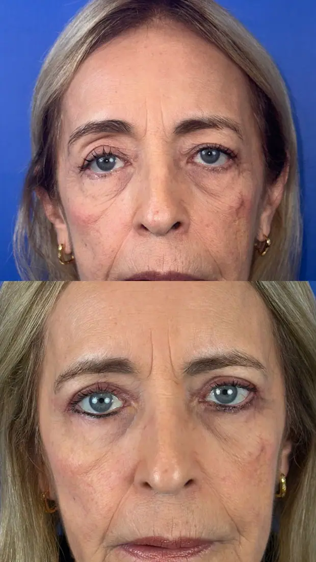 Blefaroplastia, antes e depois. Ptose, blefaroplastia superior e inferior e cantopexia.
